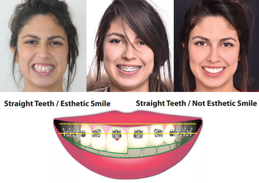 Photo collage shows the difference between Pitts 21 and traditional braces.  The top row shows 3 young women smiling and how the Pitts 21 allows more of the smile to show.  The second row image shows how the Pitts 21 brace is placed higher on the tooth than a traditional brace.