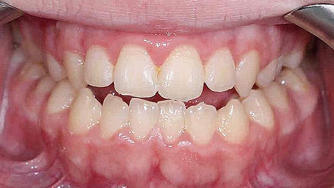 Before and after dental treatment at Chun Orthodontics